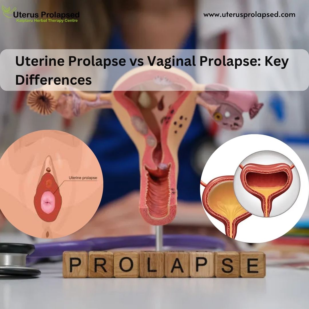 Uterine Prolapse vs Vaginal Prolapse