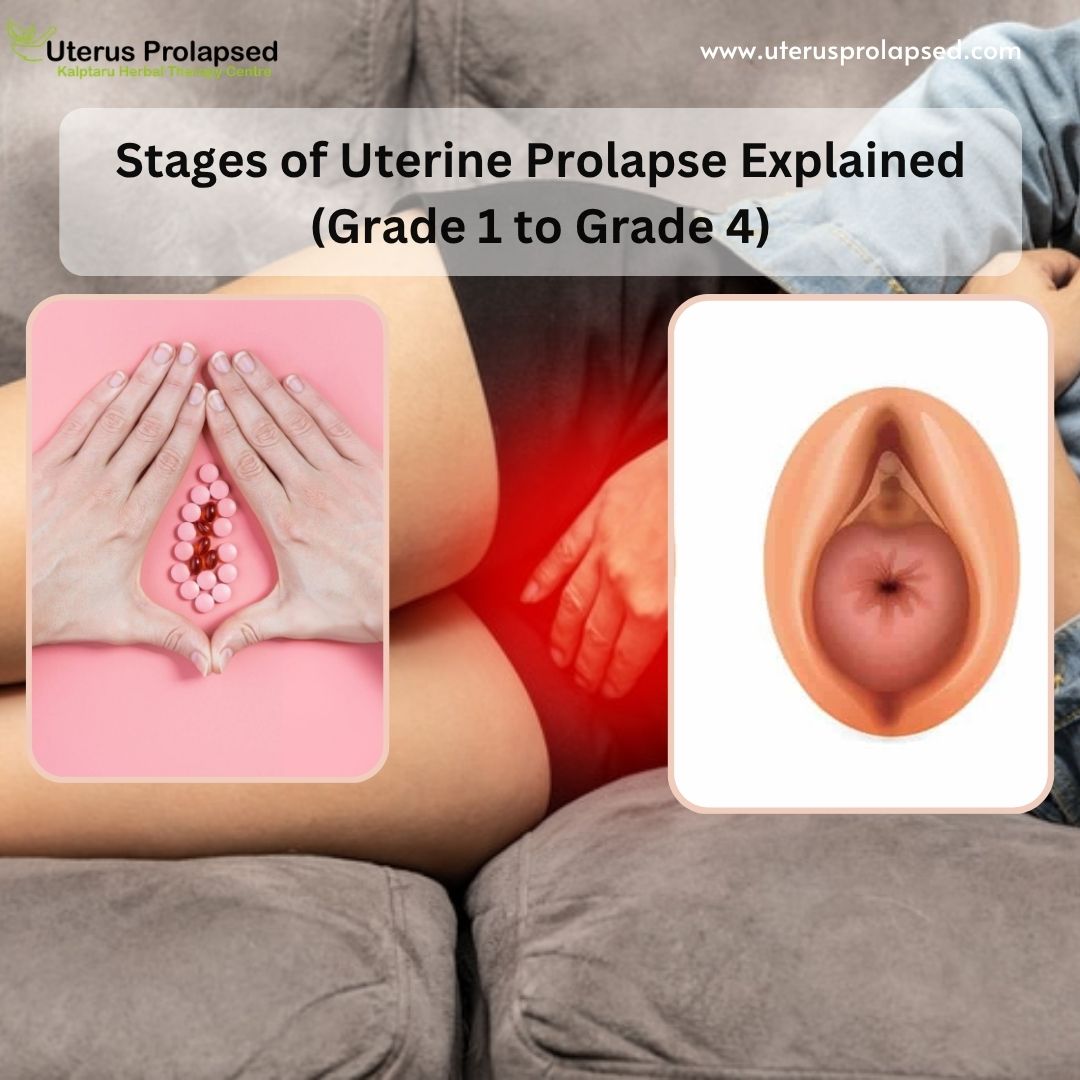 Uterine Prolapse