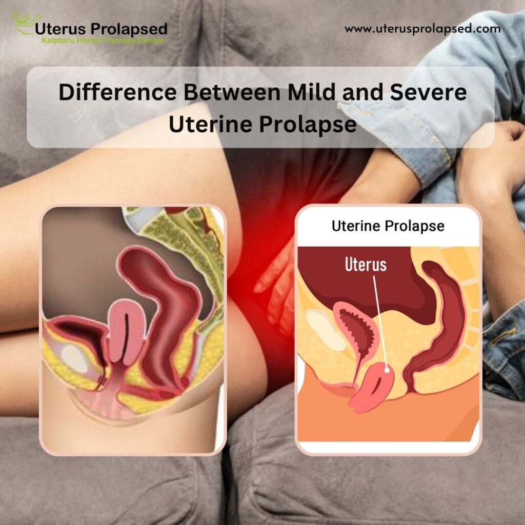 Uterine Prolapse