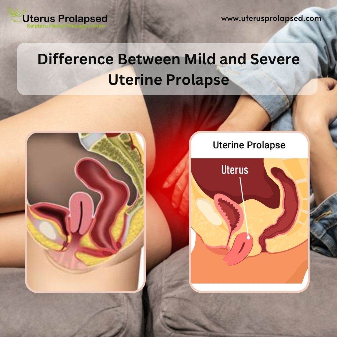 Uterine Prolapse