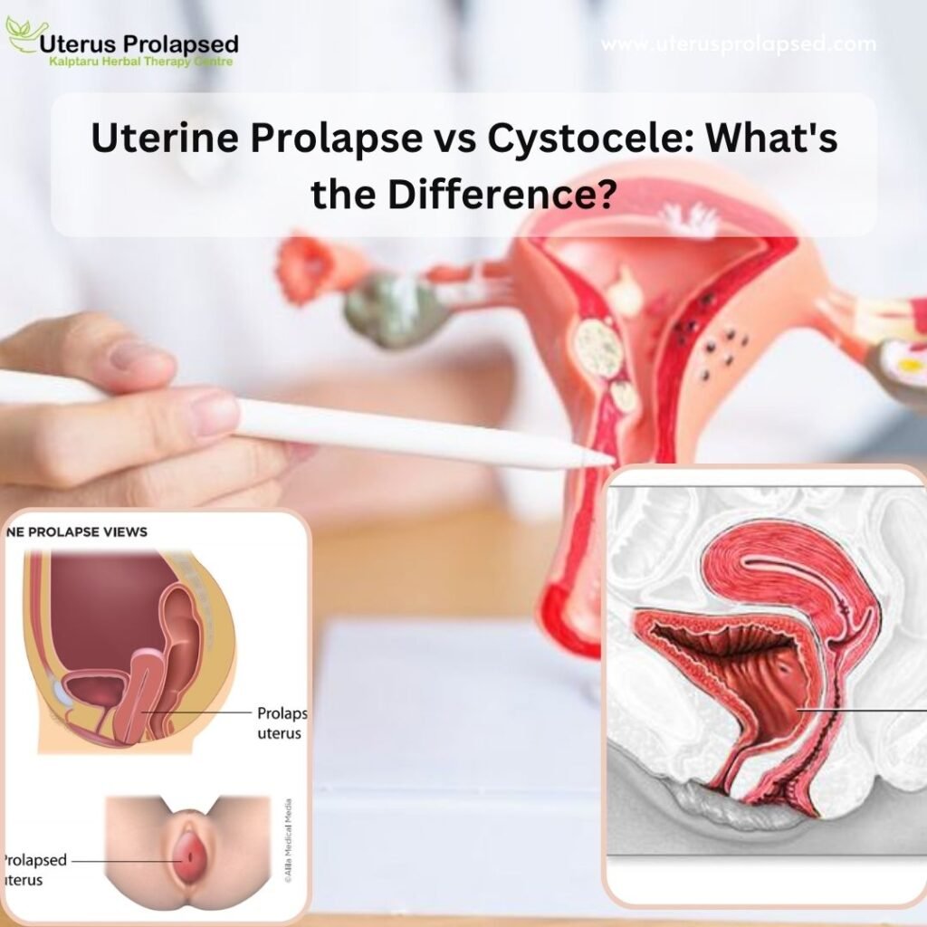 Uterine-Prolapse-vs-Cystocele