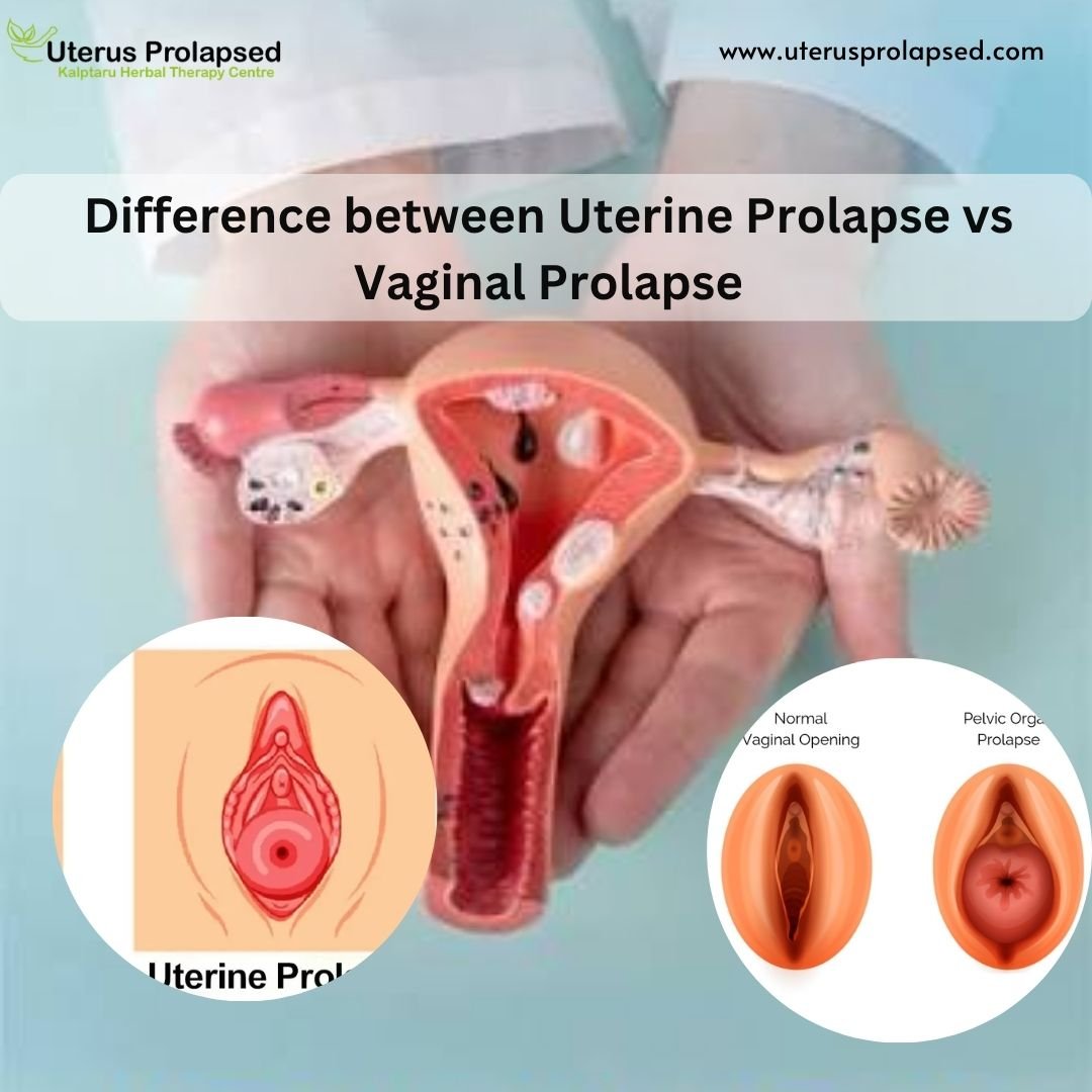 Uterine Prolapse